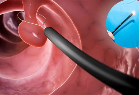 Advanced GI Endoscopy - Surat Gestro Center