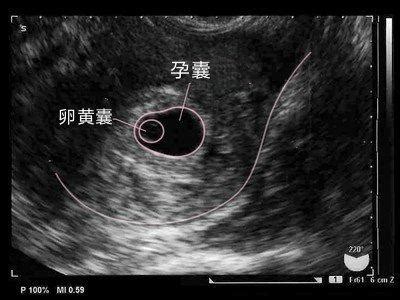 孕6周了, 为什么孕囊很小, 该怎么办?|孕囊|妊娠|孕周_新浪新闻