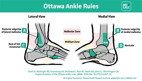 Ottawa Ankle Rule - MDCalc