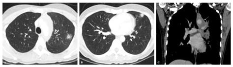 Chest Imaging in Systemic Endemic Mycoses