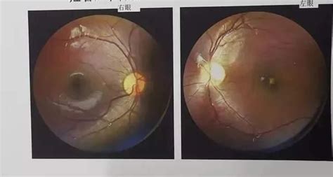 成都激光手术治近视眼价格 眼睛近视了怎样才能恢复 - 知乎