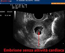 gestazionale senza embrione cause gestazionale senza embrione cause