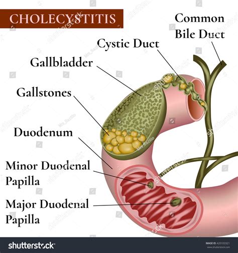 Cholecystitis. Inflammation Of The Gallbladder And Bile Ducts ...