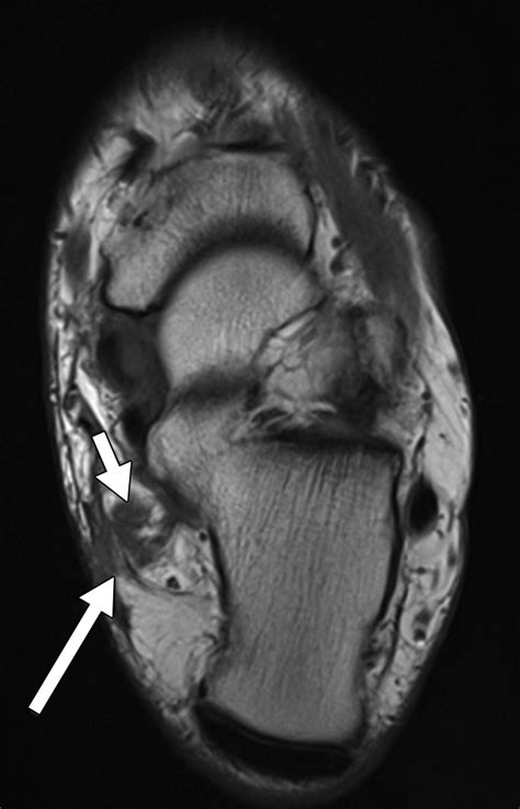Tarsal Tunnel Syndrome Mri - tarsal tunnel syndrome remedies