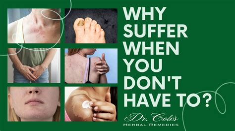 dr coles herbal remedies