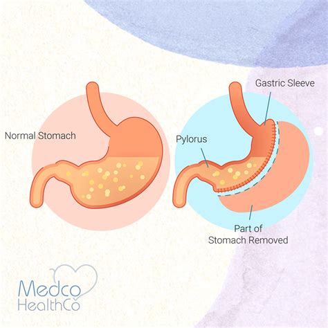 Gastric Sleeve Surgery | Medco Healthco | Stay Safe and Healthy