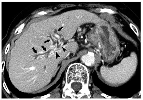 Cancers | Special Issue : Hepatobiliary Cancers