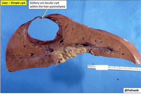 Liver – Cyst – NUS Pathweb :: NUS Pathweb