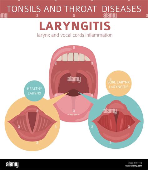 Tonsils and throat diseases. Laryngitis symptoms, treatment icon set. Medical infographic design ...