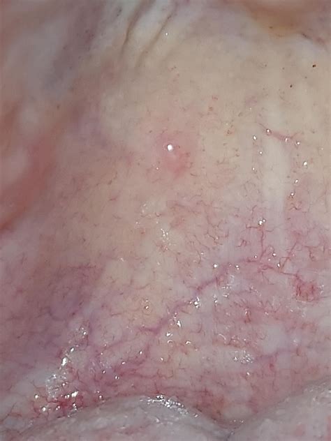 Is this a mucocele on my palate? Can a mucocele leave a somewhat scar ...
