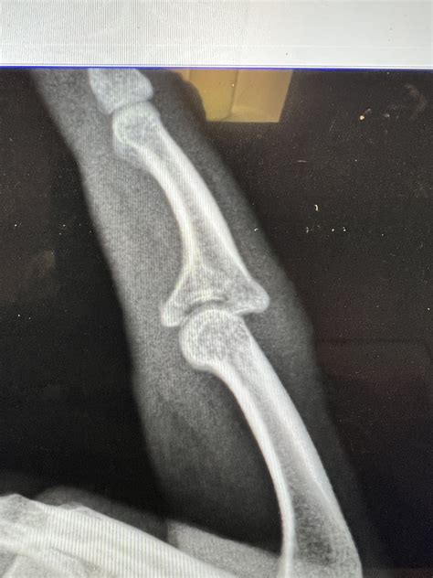 Jammed Finger (Sprain or Fracture) | Denver, Colorado — Dr. Nick Golinvaux