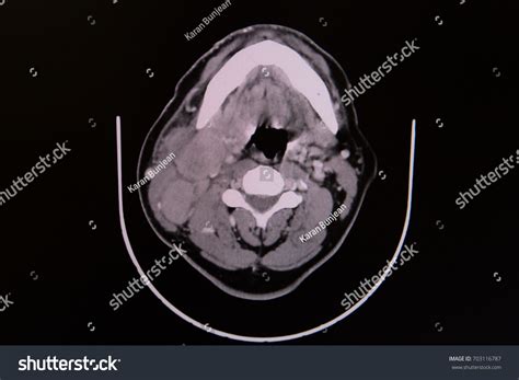 Ct Scan Neck Showing Enlarged Multiple foto stock 703116787 | Shutterstock