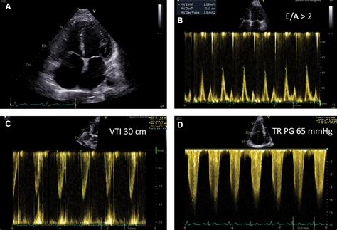 Case of High Output Heart Failure Caused by Renal Clear Cell Carcinoma | Circulation: Heart Failure