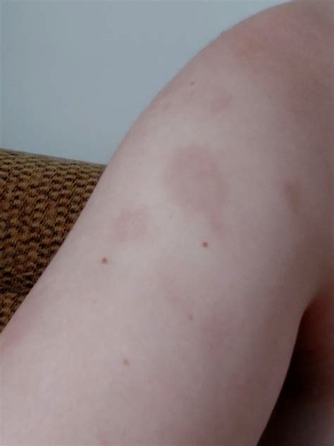 Brown Spots On Both Arms at Helen Rooker blog