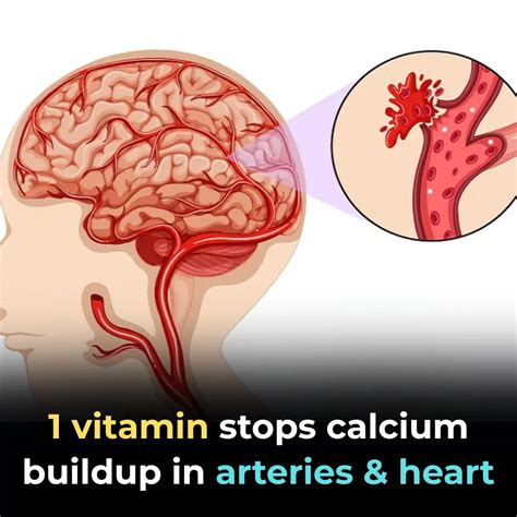 1 Vitamin Stops Calcium Buildup in Arteries and Heart