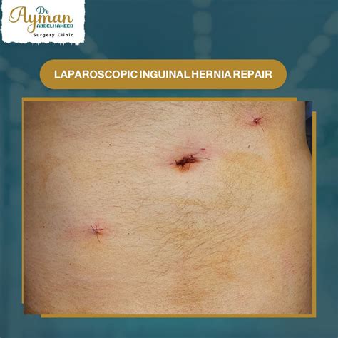 laparoscopic inguinal hernia repair - #site_titleLaparoscopic Inguinal Hernia Repair