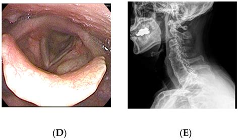 Cervical Osteophytes