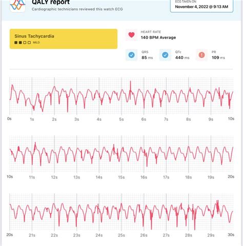 All cardio buddies: Does this interpretation look like Sinus tachy? A ...
