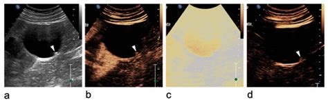 CEUS in Atypical Renal Cystic Masses: How, When and Why