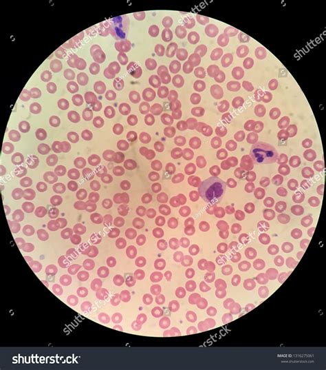 Peripheral Blood Smear Normal Red Blood Foto stock 1316275061 ...