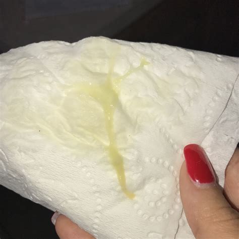 Jelly Discharge At 37 Weeks Pregnant at Anthony Hudson blog