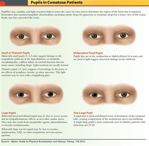 Dilated Pupils Vs Constricted Pupils