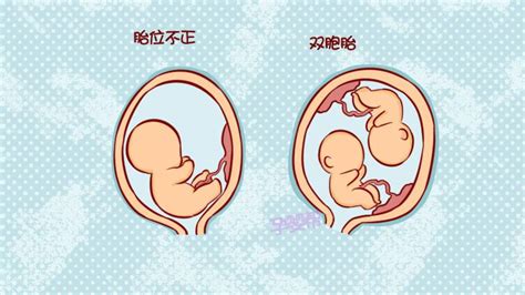 怀孕七个月胎位臀位图,怀孕八个月横位胎位图 - 伤感说说吧