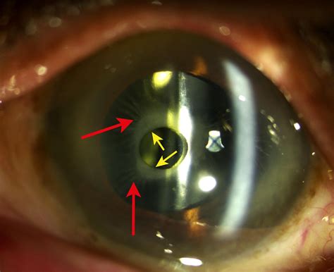 Anterior capsular phimosis | The BMJ