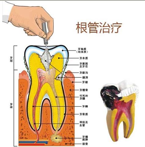 牙髓炎图片 (30)_有来医生