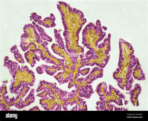 Brain tumour. Light micrograph (LM) of a section of an affected human brain. Choroid plexus ...