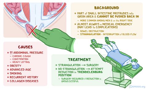 Incarcerated Inguinal Hernia: What Is It, Diagnosis, and More | Osmosis