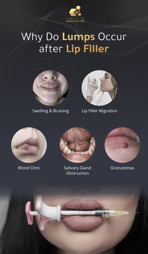 Lump Inside Lip After Filler – Causes & Solutions - YSC