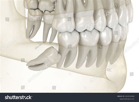 Mesial Impaction Wisdom Teeth Medically Accurate Stock Illustration 2224159269 | Shutterstock