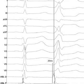 Image result for PVC Localization