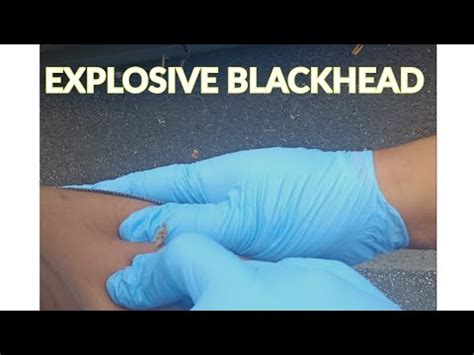 Image result for Exploding Pimples 2017