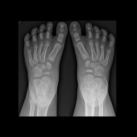 Kohler Disease | Pediatric Radiology Reference Article | Pediatric Imaging | @pedsimaging