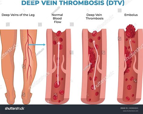 Illustration Deep Vein Thrombosis Diagram Dvt Stock Vector (Royalty ...