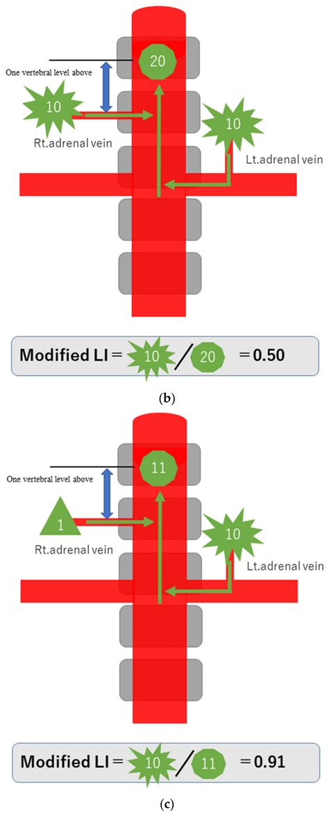 An Ancillary Method for Adrenal Venous Sampling in Cases in Which Right Adrenal Vein Sampling Is ...
