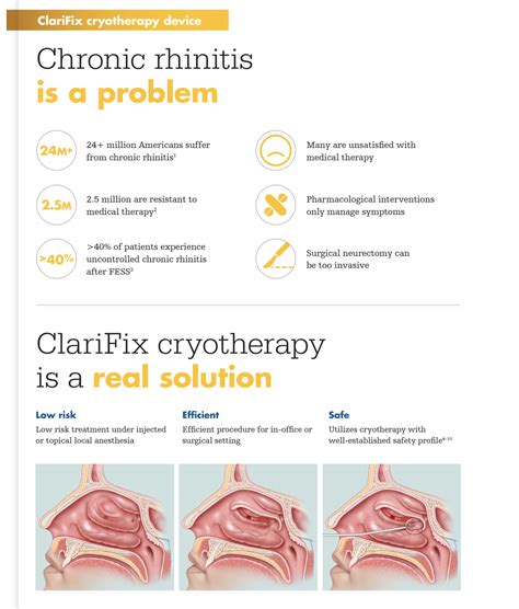ClariFix®: Relief from Chronic Rhinitis | Ascentist Healthcare