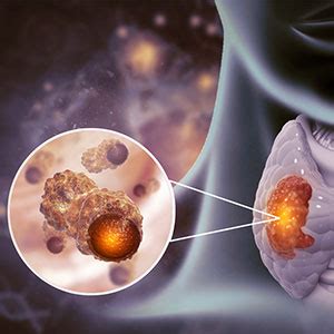 Thyroid Cancer Therapy in Hyderabad | Endocrine Malignancies in Bandlaguda