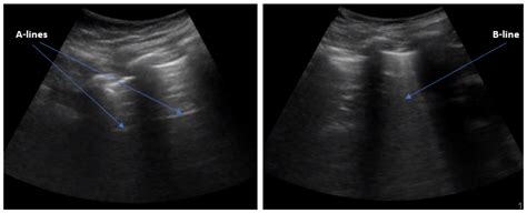 B-Line Detection and Localization in Lung Ultrasound Videos Using Spatiotemporal Attention