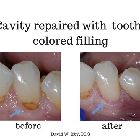 Cavity Filling Before And After