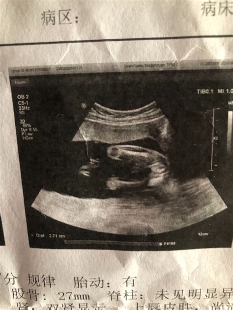怀孕12周3个月B超，胎儿在动，惊喜不断！_腾讯视频