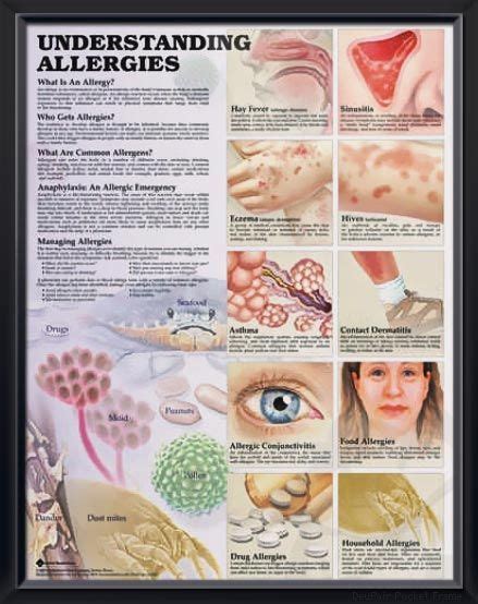 what are common allergies
