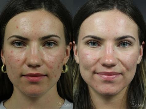 Acne: Laser Treatment Before & After Gallery