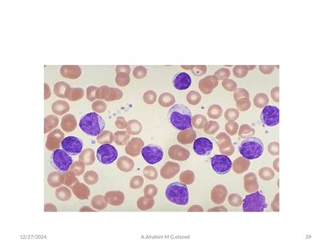 Leukaemias Diagnosis acute leukaemia and chronic | PPT