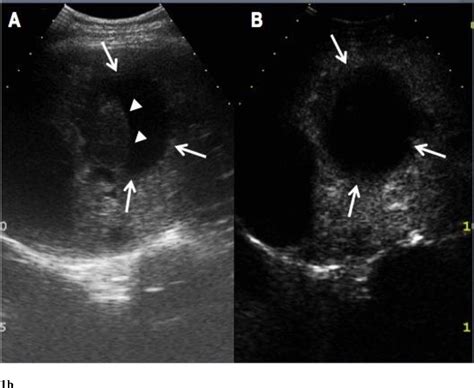 Hepatic Cyst