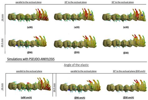 Upper First Molar and Second Premolar Distalization with Clear Aligner ...