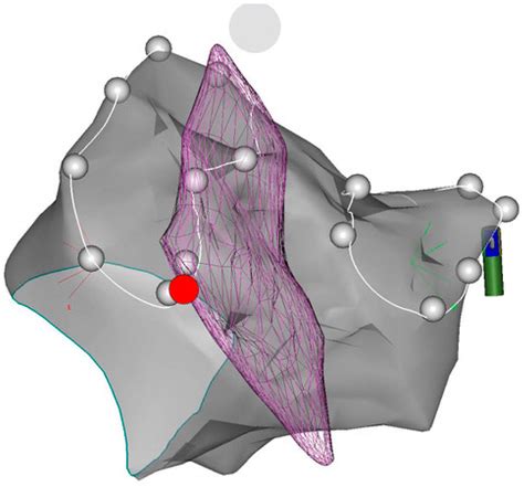 Assessment of Esophageal Shifts during Catheter Ablation of Atrial ...