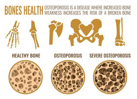 Can Osteoporosis Be Reversed Naturally? Yes!